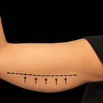 17. MG Beauty Clinic - Immagini Sito Shop - Fili di Trazione Braccia