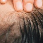 MG Beauty Clinic - Immagini Sito Shop - BOTOX PER IPERIDROSI CUOIO CAPELLUTO