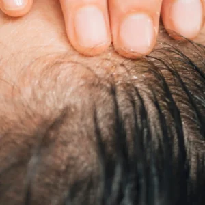 MG Beauty Clinic - Immagini Sito Shop - BOTOX PER IPERIDROSI CUOIO CAPELLUTO