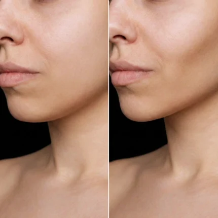 MG Beauty Clinic - Immagini Sito Shop - CHIRURGIA CONTORNO MANDIBOLARE