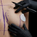 MG Beauty Clinic - Immagini Sito Shop - CHIRURGIA DEL CAPEZZOLO O AREOLA (2)