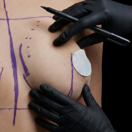 MG Beauty Clinic - Immagini Sito Shop - CHIRURGIA DEL CAPEZZOLO O AREOLA (2)