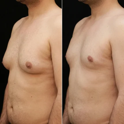 MG Beauty Clinic - Immagini Sito Shop - GINECOMASTIA (2)