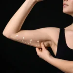 MG Beauty Clinic - Immagini Sito Shop - LIFTING BRACCIA