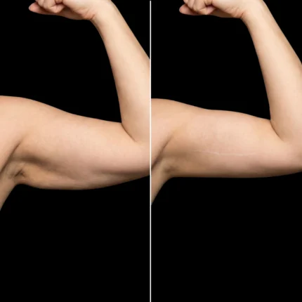 MG Beauty Clinic - Immagini Sito Shop - LIFTING BRACCIA (2)