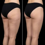 MG Beauty Clinic - Immagini Sito Shop - LIFTING COSCE (2)