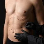 MG Beauty Clinic - Immagini Sito Shop - LIPOADDOMINOPLASTICA