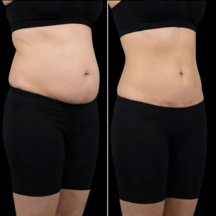 MG Beauty Clinic - Immagini Sito Shop - LIPOADDOMINOPLASTICA (2)