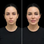 MG Beauty Clinic - Immagini Sito Shop - LIPOFILLING (2)