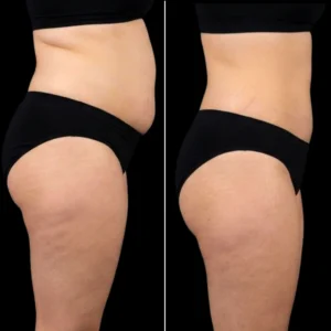 MG Beauty Clinic - Immagini Sito Shop - LIPOSUZIONE (2)