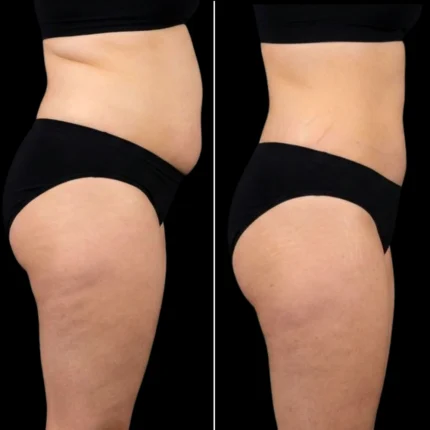 MG Beauty Clinic - Immagini Sito Shop - LIPOSUZIONE (2)