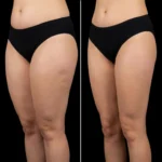 MG Beauty Clinic - Immagini Sito Shop - LIPOSUZIONE cosce (2