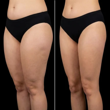 MG Beauty Clinic - Immagini Sito Shop - LIPOSUZIONE cosce (2