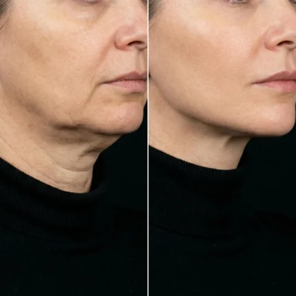 MG Beauty Clinic - Immagini Sito Shop - Lifting collo (2)