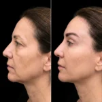 MG Beauty Clinic - Immagini Sito Shop - Lifting temporale (2)