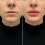 MG Beauty Clinic - Immagini Sito Shop - Lip Lift (2)