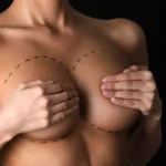 MG Beauty Clinic - Immagini Sito Shop - Mastopessi