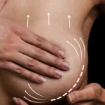 MG Beauty Clinic - Immagini Sito Shop - Mastopessi (2)