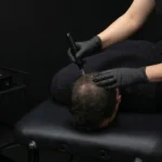 MG Beauty Clinic - Immagini Sito Shop - Microneedling Cuoio capelluto