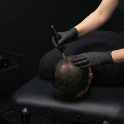 MG Beauty Clinic - Immagini Sito Shop - Microneedling Cuoio capelluto