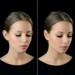 MG Beauty Clinic - Immagini Sito Shop - OTOPLASTICA (2)