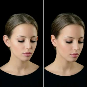 MG Beauty Clinic - Immagini Sito Shop - OTOPLASTICA (2)