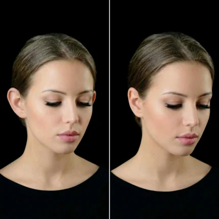 MG Beauty Clinic - Immagini Sito Shop - OTOPLASTICA (2)