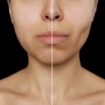 MG Beauty Clinic - Immagini Sito Shop - RESEZIONE BOLLA DI BICHAT (2)