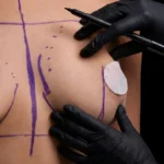 MG Beauty Clinic - Immagini Sito Shop - Ricostruzione Mammaria (2)