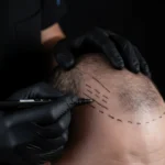 MG Beauty Clinic - Immagini Sito Shop - TRAPIANTO FUE