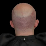 MG Beauty Clinic - Immagini Sito Shop - TRAPIANTO FUE (2)