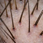 MG Beauty Clinic - Immagini Sito Shop - TRICOGRAMMA (2)