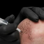 MG Beauty Clinic - Immagini Sito Shop - TRICOPIGMENTAZIONE (2)