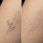 MG Beauty Clinic - Immagini Sito Shop - Scleroterapia (2)