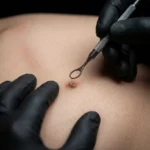 MG Beauty Clinic - Immagini Sito Shop - curettage (2)