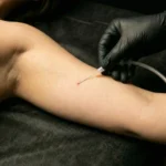 MG Beauty Clinic - Immagini Shop - Carbossiterapia Braccia