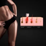 MG Beauty Clinic - Immagini Sito Shop - Epilazione Donna