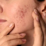 MG Beauty Clinic - Immagini sito shop - Cicatrici Acne Viso Parziale