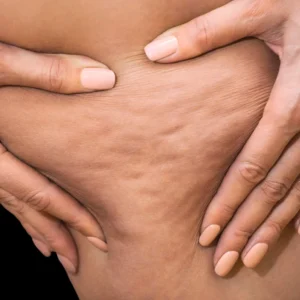 MG Beauty Clinic - Immagini sito shop - Body Shape Pro - cellulite edematosa gambe e glutei