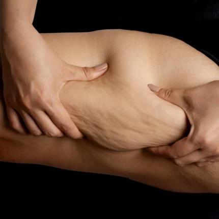 MG Beauty Clinic - Immagini sito shop - Body Shape Pro - cellulite fibrotica gambe e glutei