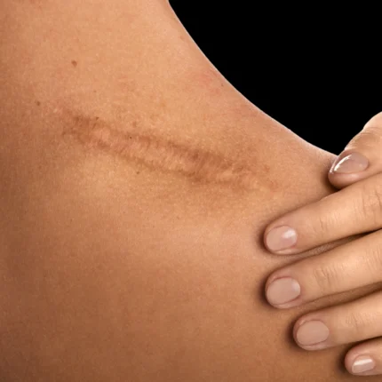 MG Beauty Clinic - Immagini sito shop - Body Shape Pro - cicatrici cutanee localizzate