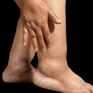 MG Beauty Clinic - Immagini sito shop - Body Shape Pro - trattamento edemi e cicatrici