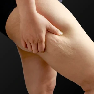 MG Beauty Clinic - Immagini sito shop - Body Shape Pro - trattamento fibrosi localizzata