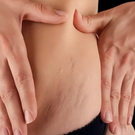 MG Beauty Clinic - Immagini sito shop - Smagliature Localizzate (2)