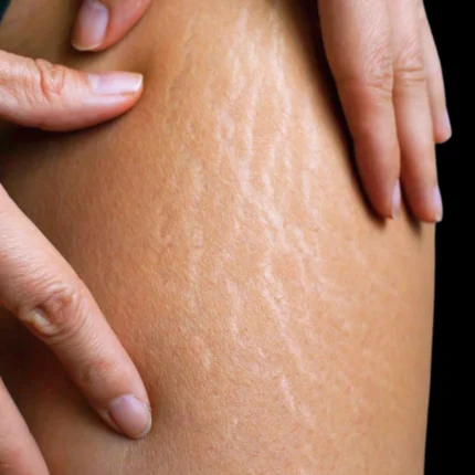 MG Beauty Clinic - Immagini sito shop - Smagliature Localizzate