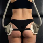 MG Beauty Clinic - Immagini sito shop - Laser Shape Glutei