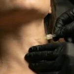 MG Beauty Clinic - Immagini Shop - Carbossiterapia Collo