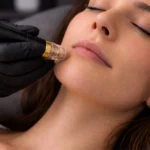 Radiofrequenza Nasogeniene - MG Beauty Clinic - Immagini sito shop